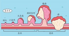 无锡医博肛泰打假：做一次肠镜能保10年平安（假的）